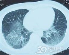 急性间质性肺炎