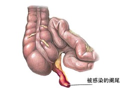急性阑尾炎