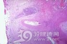 急性失血所致贫血