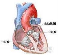 急性特发性心包炎