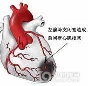 急性心肌梗死