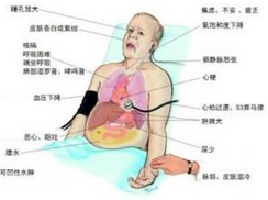 急性左心衰