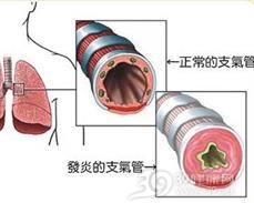 急性支气管炎