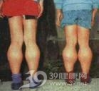 肌营养不良症