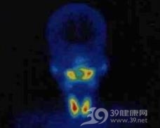 甲状旁腺功能亢进症