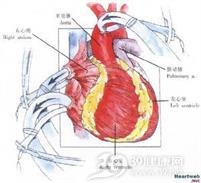矫正型大动脉错位