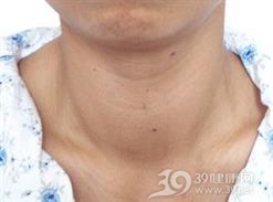 甲状腺功能亢进伴发的精神障碍