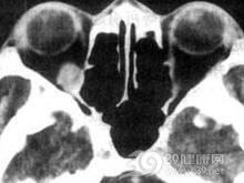 甲状腺相关眼病