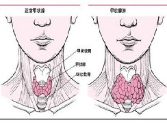 甲状腺炎