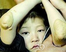 家族性异常β脂蛋白血症