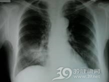 Kartagener综合征