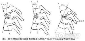 卡普兰综合征
