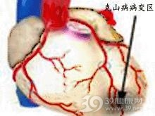 克山病