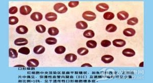 口形红细胞增多症