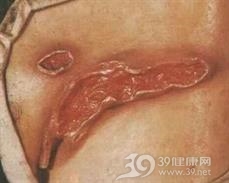 溃疡病出血