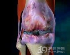 淋病性关节炎