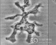 朗格汉斯组织细胞增多症