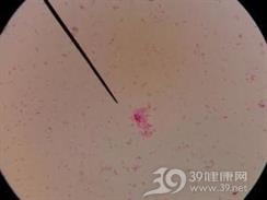 流感嗜血杆菌脑膜炎