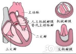 联合瓣膜病变
