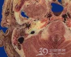 颅内静脉窦闭塞性颅高压