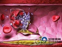 老年人脑血栓形成