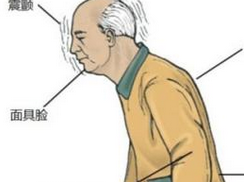 老年人帕金森病