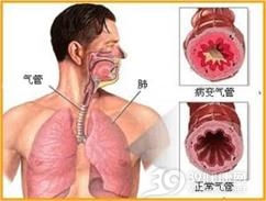 老年人支气管哮喘