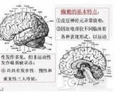 老年性癫痫