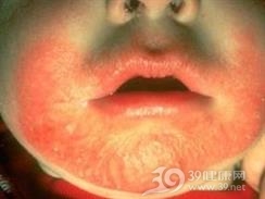 离位皮炎