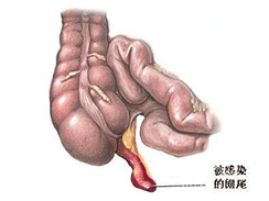 阑尾炎