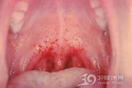 粒性白细胞缺乏性咽峡炎