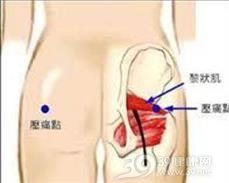 梨状肌症候群