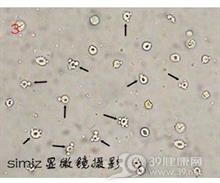 镰状细胞病