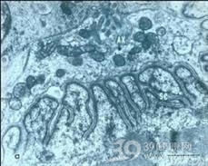 镰状细胞性肾病