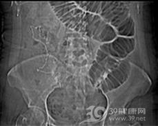 麻痹性肠梗阻