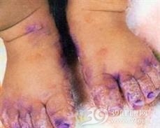 梅毒性关节炎