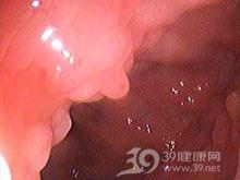 麦胶性肠病