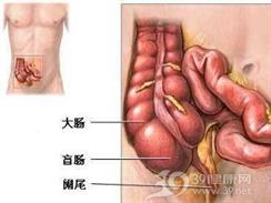 弥漫性空回肠溃疡