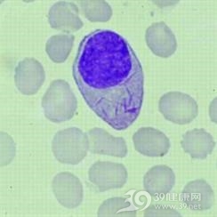 弥漫性血管内凝血