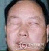 面瘫后遗症