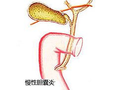 慢性胆囊炎
