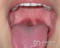 慢性舌扁桃体炎