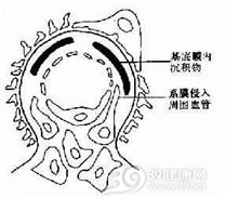 膜性肾小球肾炎