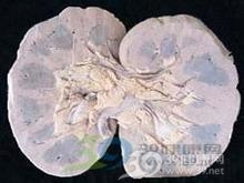 慢性肾盂肾炎