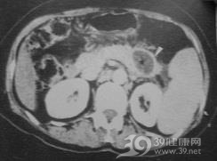 慢性胰腺炎