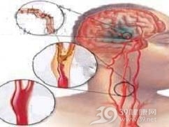 脑动脉硬化症