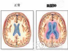 脑脓肿