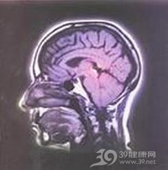 脑桥中央髓鞘溶解症