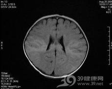 脑炎