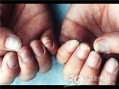 念珠菌病